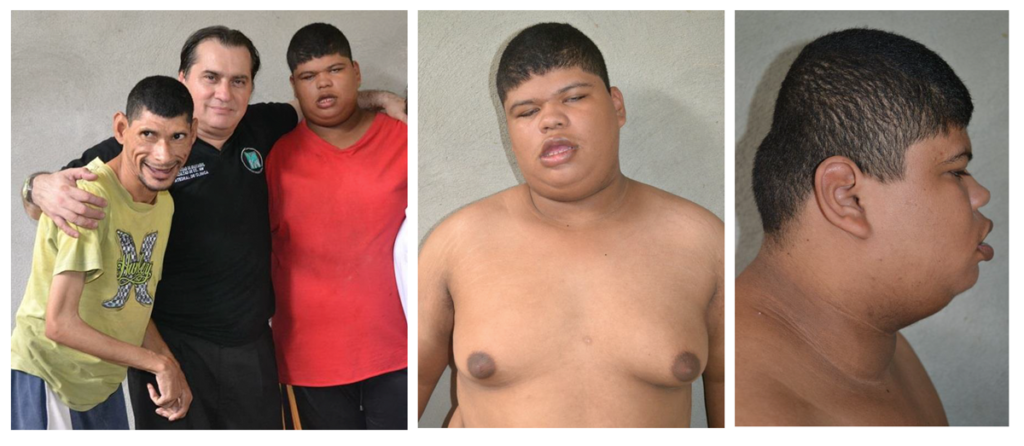 A PROPÓSITO DE DOS HERMANOS CON CRANEOSINOSTOSIS (BRAQUICEFALIA). EL UNO CON DISMORFIA MEDIOFACIAL, TRASTORNOS OCULARES, OBESIDAD, GINECOMASTIA, Y RETRASO MENTAL SEVERO (SÍNDROME DE SUMMITT).- EL OTRO CON DISMORFIA MEDIOFACIAL, SINOSTOSIS RADIOCUBITAL Y RETRASO MENTAL SEVERO. José Luis (“Gordo”.- Edad 16 años, ptosis de ambos parpados, estrabismo, pliegue de epicanto, boca grande entre abierta con algo de macroglosia, retromicrognatia. Tercio medio e inferior de la cara dismórfico, que imprimen en su cara un aspecto bobalicon. Obesidad mórbida, perímetro cefálico 41cms (-17 DE), perímetro abdominal 126cms. Acantosis nigricans de grandes pliegues. Braquicefalia (cráneo en torre) con retraso mental severo (idiocia). Examen de los genitales, sin interés y acorde a su edad. Afasia, pero si entiende órdenes. Ginecomastia importante, (no galactorrea). No víscero ni adenomegalias. La auscultación cardiorrespiratoria anodina. Gracioso y amable. Inicialmente lo filie dentro de los síndromes adiposogenitales, pensando por su fenotipo en un Prader-Willi, sin embargo, el estudio de los genitales descarto este síndrome. Signos evidentes de resistencia a la insulina (acantosis nigricans de grandes pliegues). En la foto el autor con los dos pacientes. Nota: el autor junto a sus pacientes.