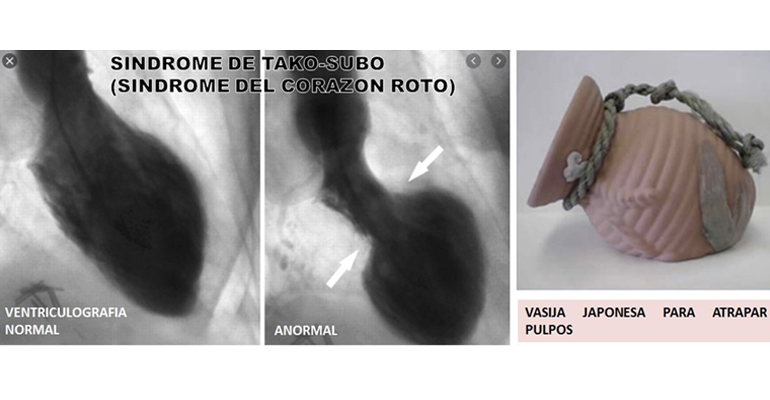 sindrome-tako-subo